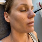 efter microneedling