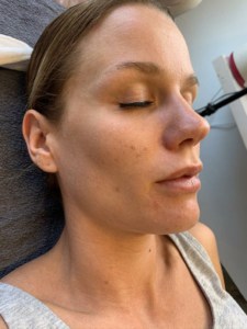 efter microneedling