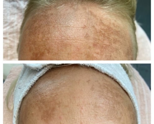 før og efter microneedling behandling