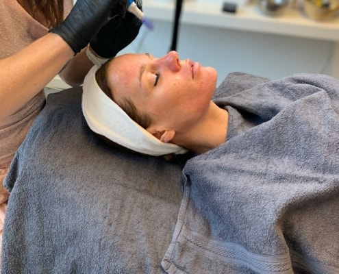 microneedling i Bellissimo Hudplejeklinik